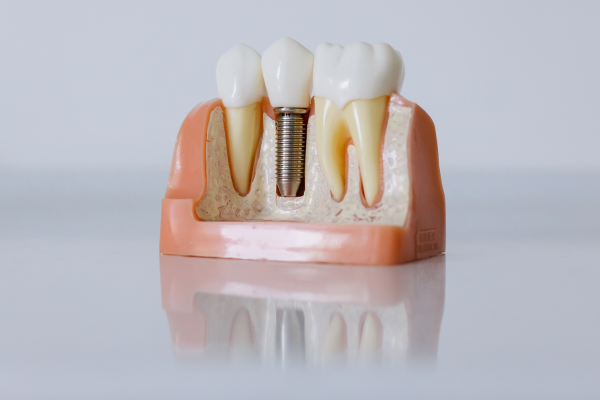 インプラントの模型