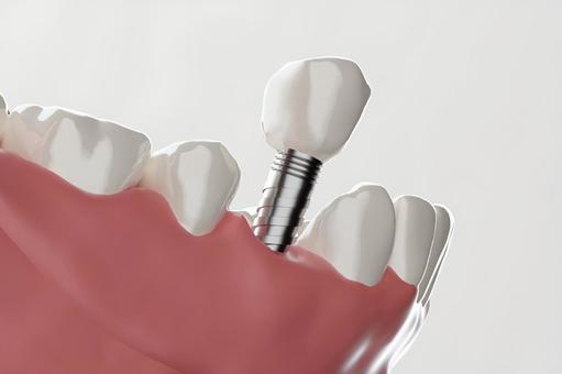 インプラトのイメージ画像