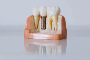 インプラントの模型